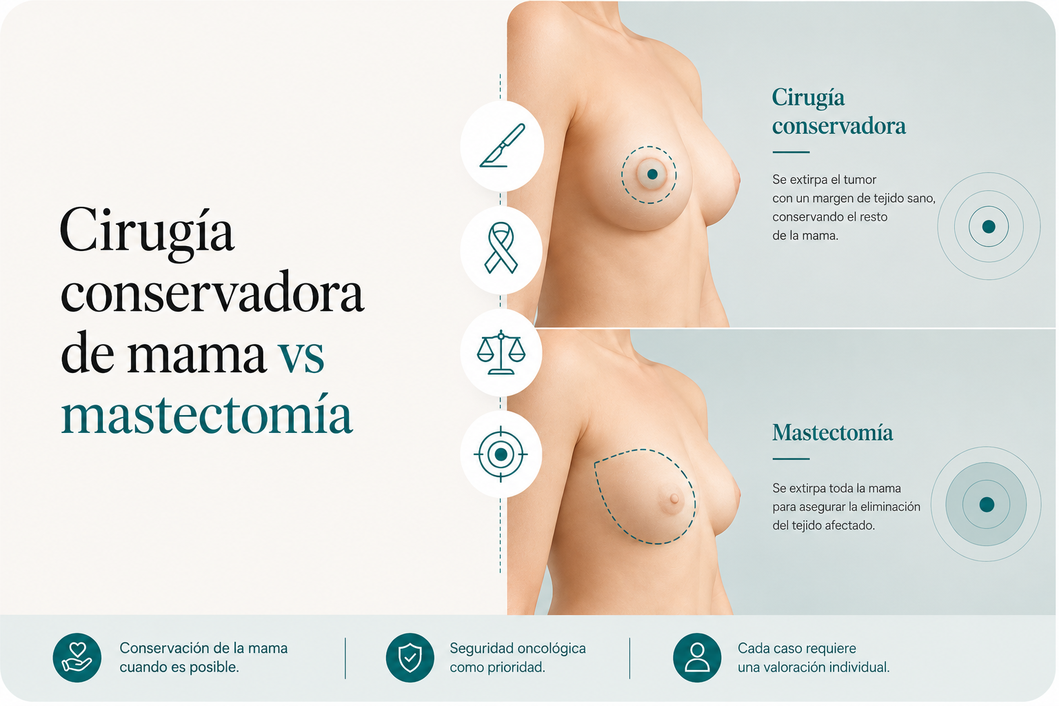 Cirugía conservadora vs. mastectomía: cómo se decide el tratamiento del cáncer de mama